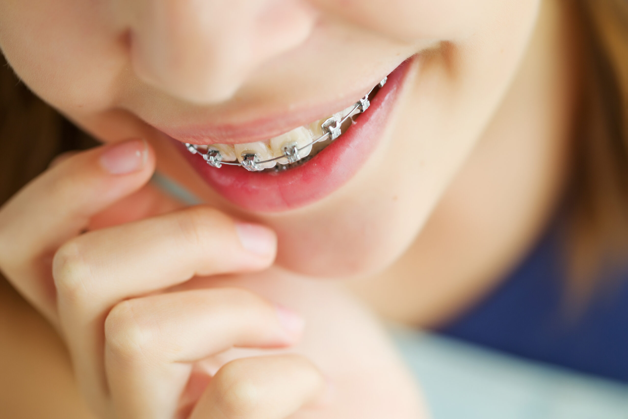 Find braces in Mooresville